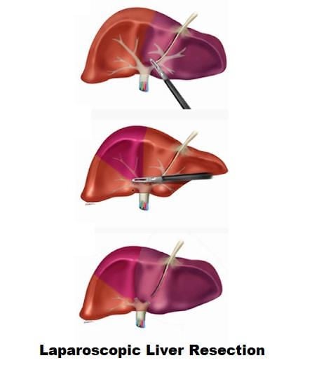 Laparoscopic Technique Of Liver Resection 3985